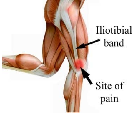 Iliocostal friction syndrome - Wikipedia