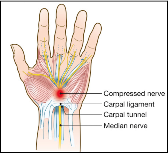 How to fix your hand and wrist pain with physiotherapy