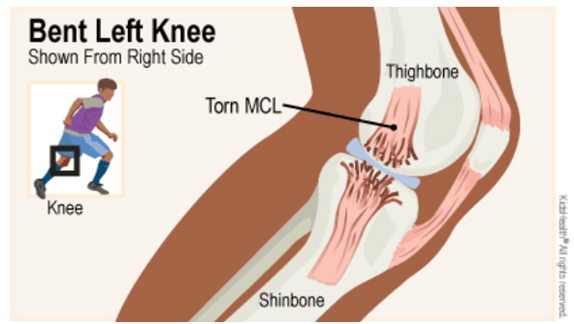 What Does An Mcl Sprain Feel Like